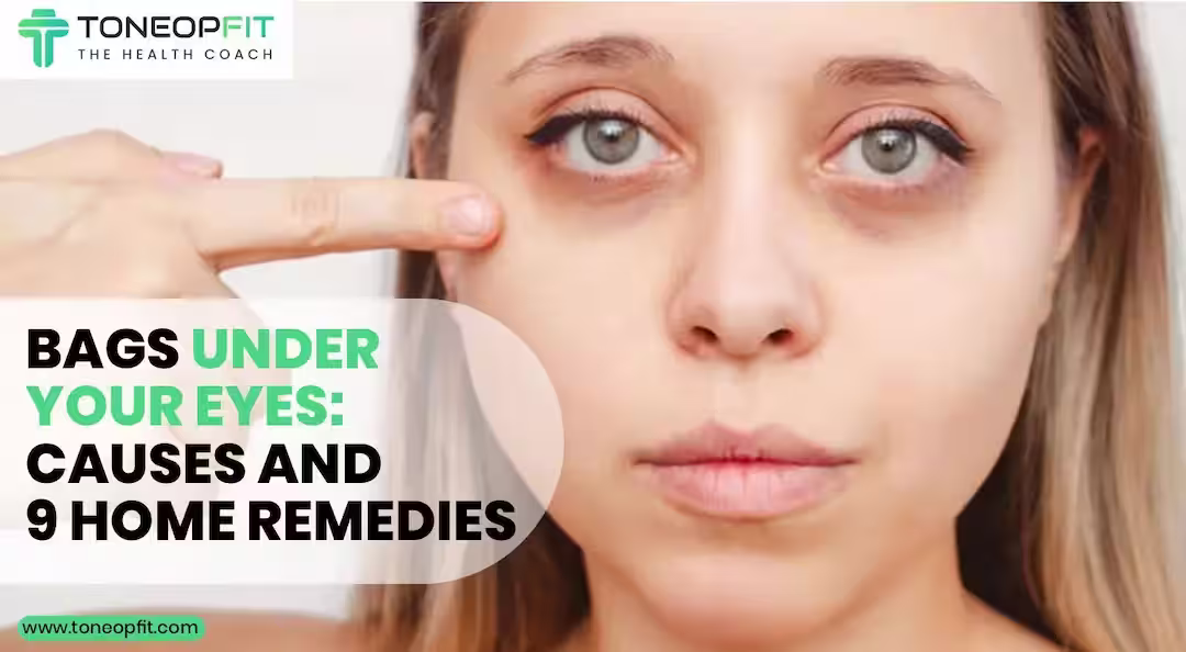 Bags Under Your Eyes: Understanding The Causes and 9 Home Remedies To Get Rid Of Puffy Eyes