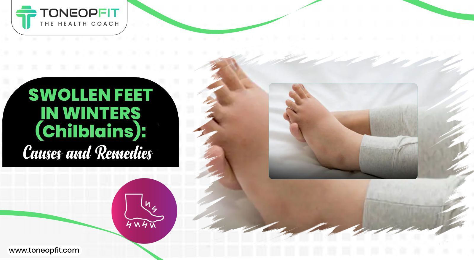 Swollen Feet In Winters (Chilblains): Causes and Remedies for Swelling In Fingers & Feet In Cold Weather